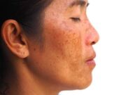 How to get rid of melasma