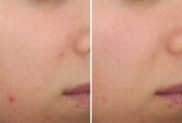 Salicylic acid for acne