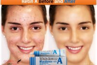 Retinol benefits for wrinkles