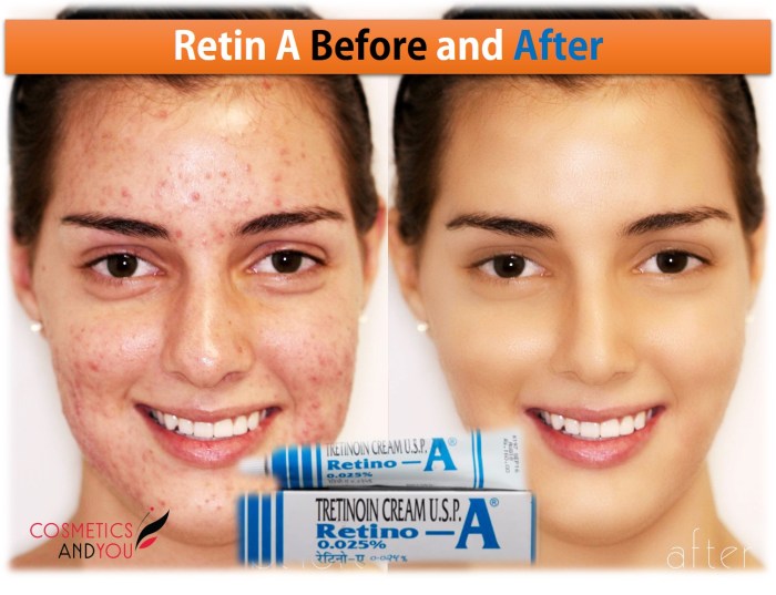 Which The Ordinary Retinol To Buy Retinol benefits for wrinkles